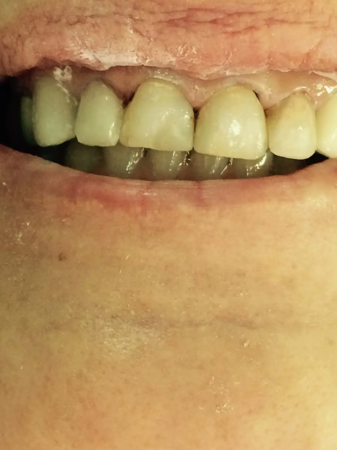 Before: Composite Veneers
